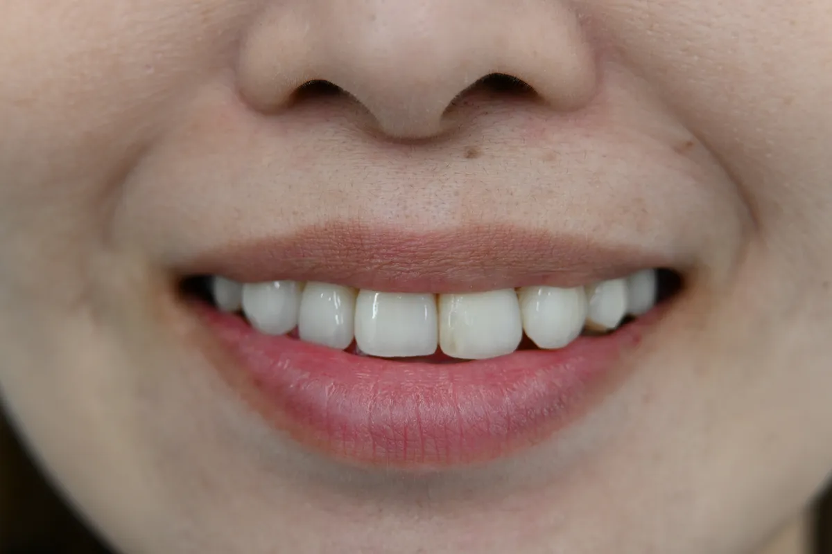 歯の黄ばみ・変色を改善 After