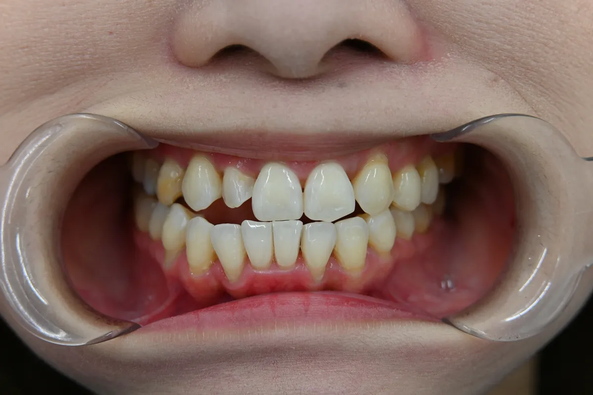 20代 女性 歯の黄ばみ・変色 Before