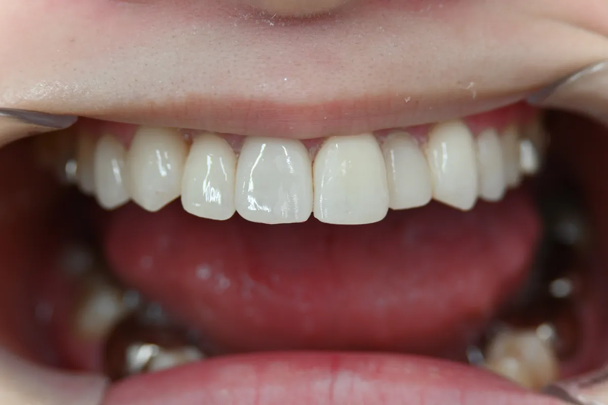 20代 女性 歯の変色・着色 After