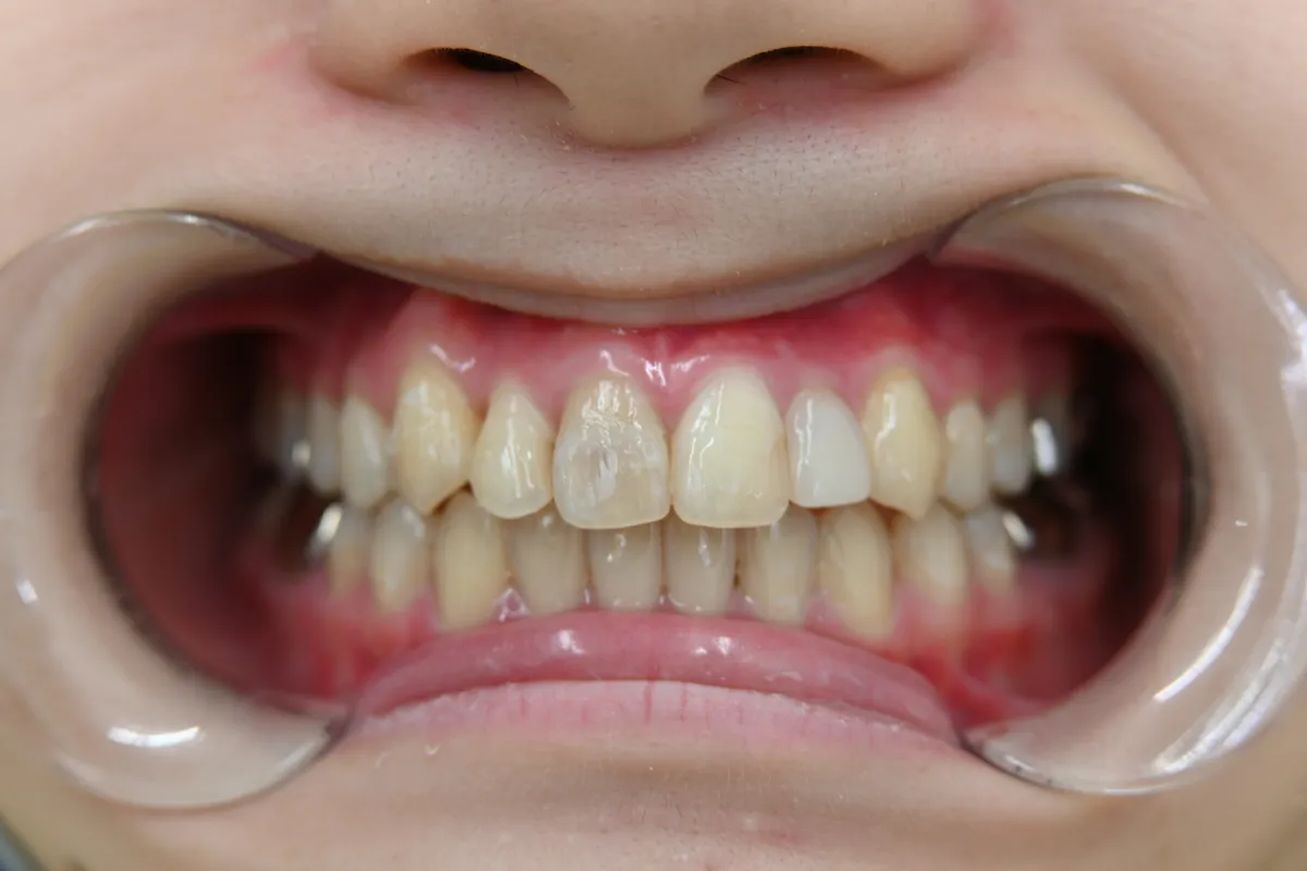 20代 女性 歯の変色・着色 Before