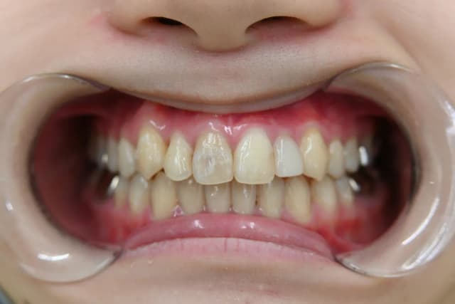 歯の色と形を自然に整える Before