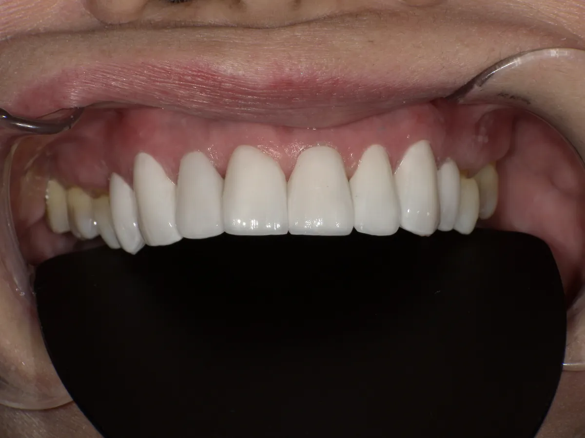 50代 女性 黄ばみ・歯間の隙間 After