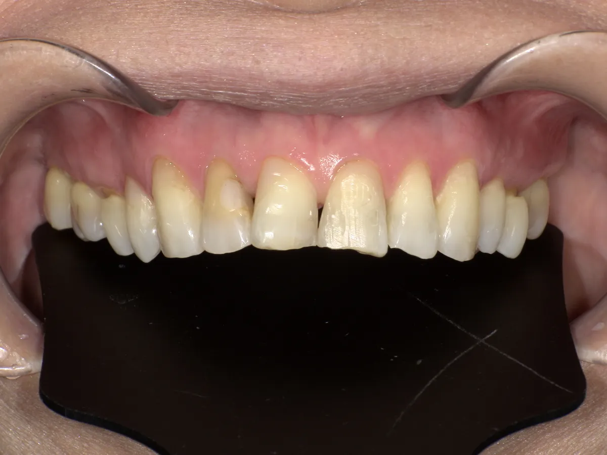 50代 女性 黄ばみ・歯間の隙間 Before
