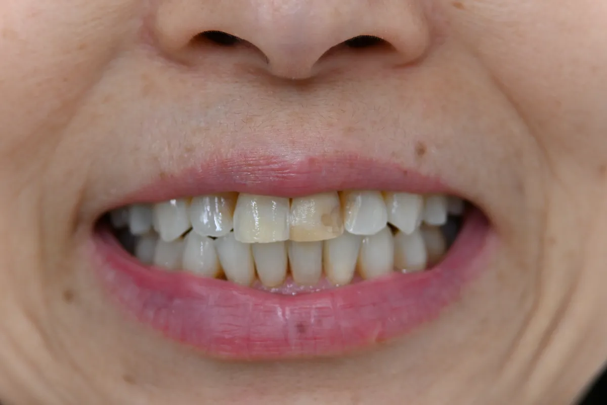 30代 女性 歯の黄ばみ Before